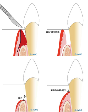歯周外科治療（APF）
